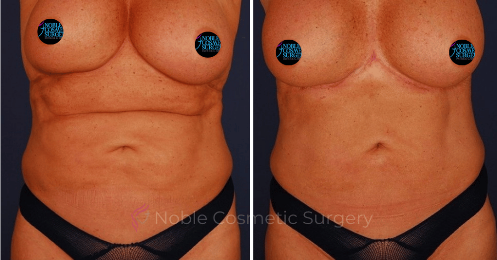 TUMMY TUCK CASE 00400