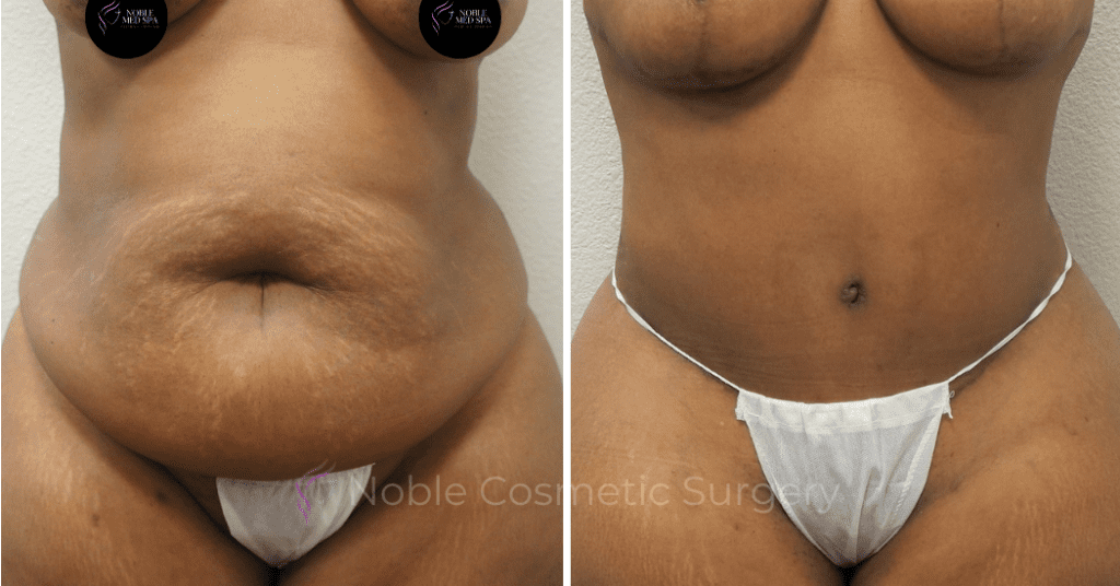 TUMMY TUCK CASE 00302
