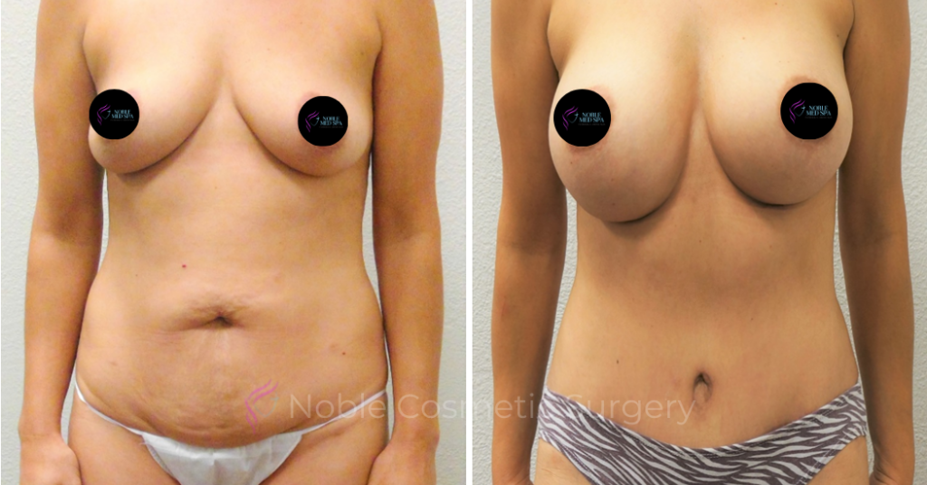 MOMMY MAKEOVER CASE 00307