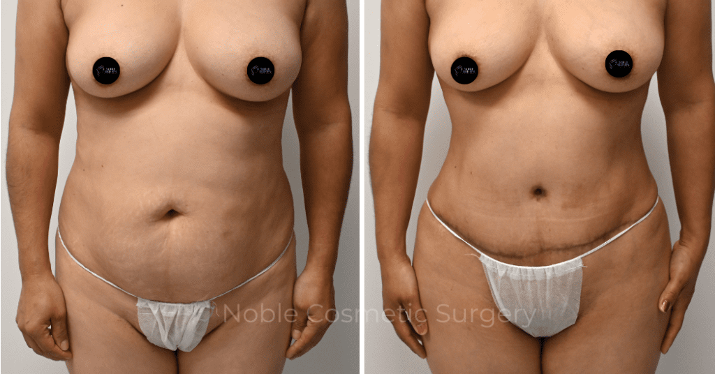 TUMMY TUCK CASE 00313