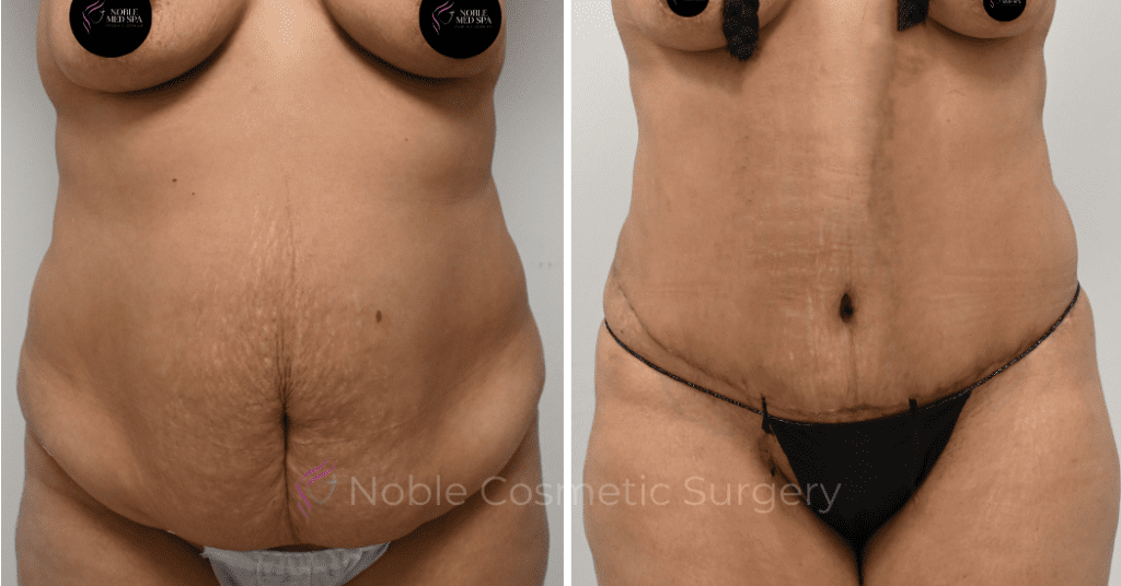 TUMMY TUCK CASE 00314