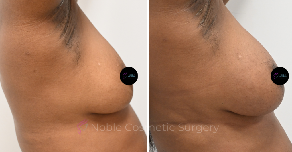 BREAST AUGMENTATION CASE 00261