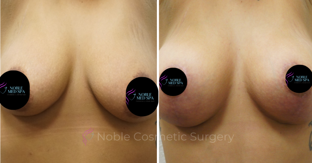 BREAST AUGUMENTATION CASE 00309