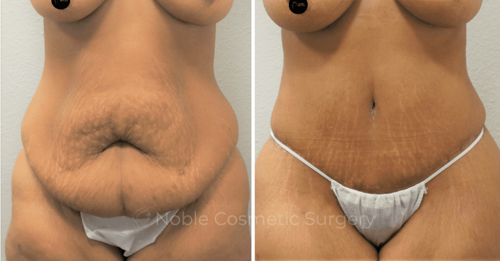 TUMMY TUCK CASE 00301
