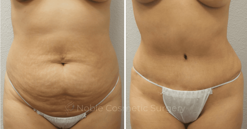 TUMMY TUCK CASE 00304