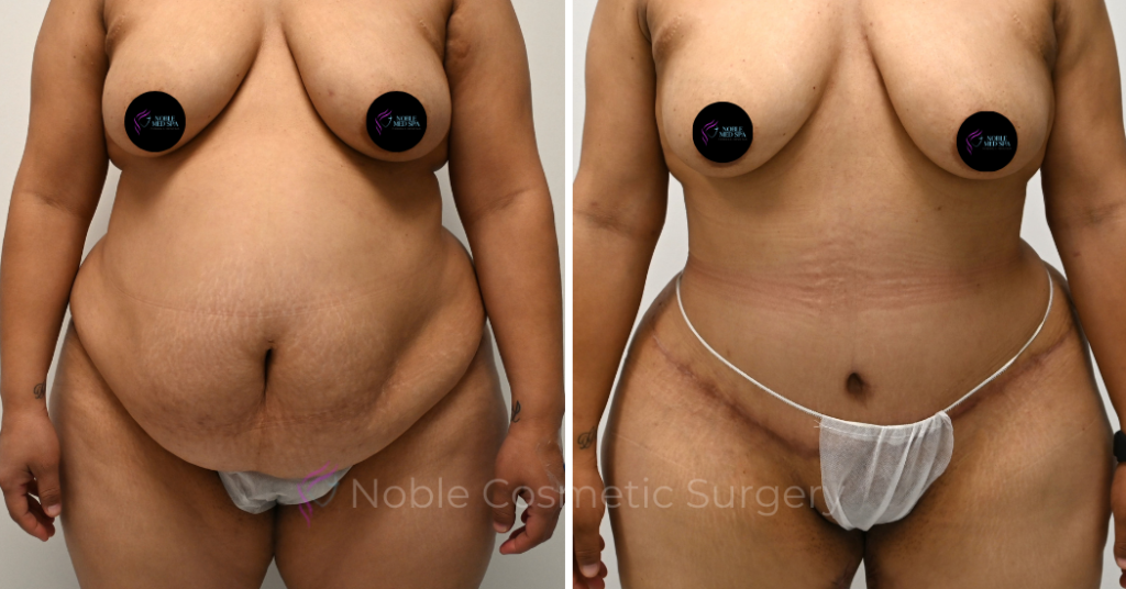 TUMMY TUCK CASE 00310