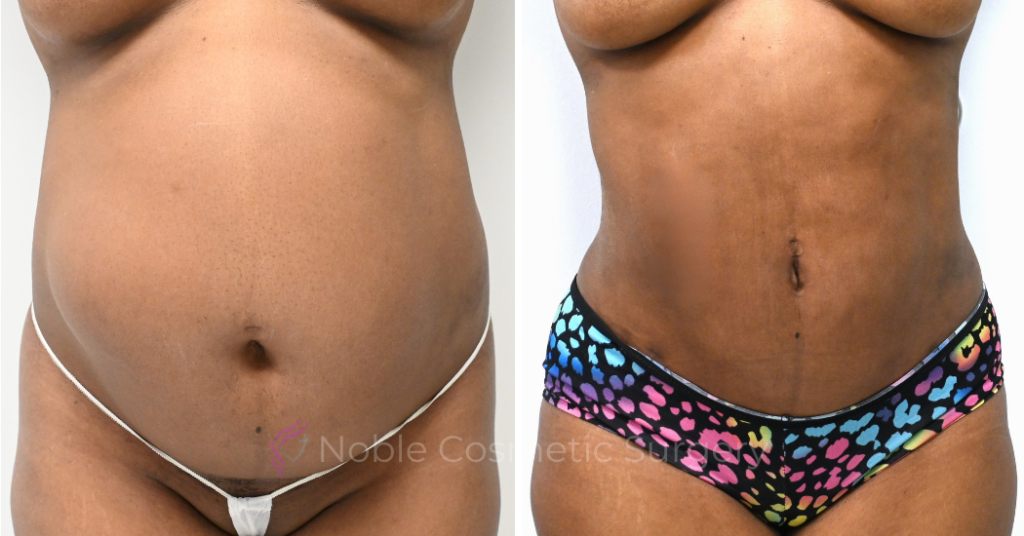 TUMMY TUCK CASE 00311