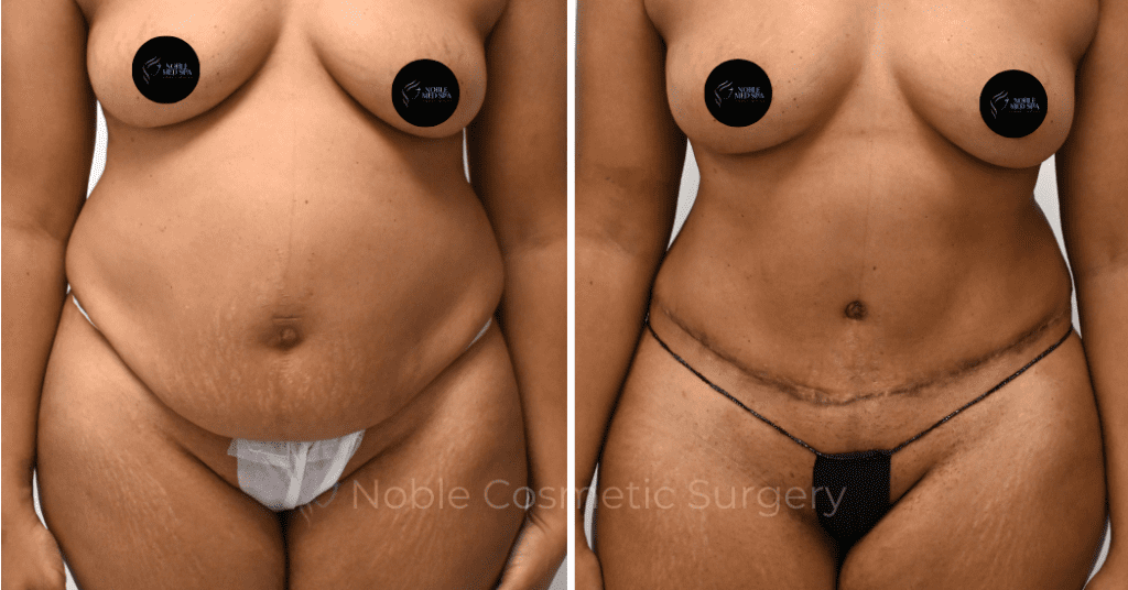 TUMMY TUCK  CASE 00312