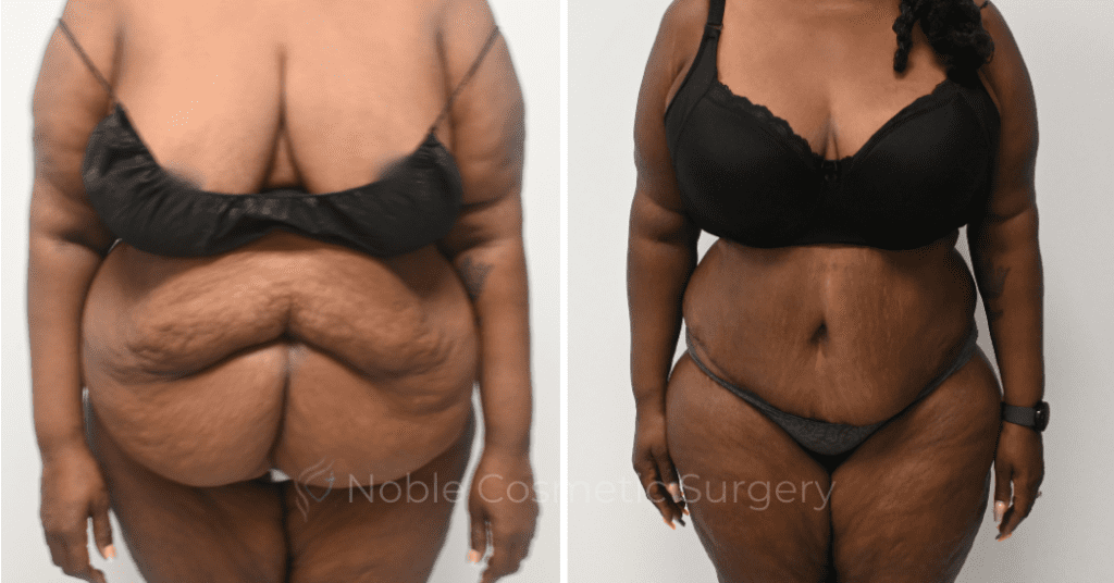 TUMMY TUCK CASE 00321