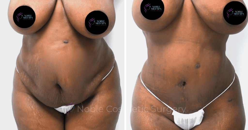 TUMMY TUCK CASE 00300