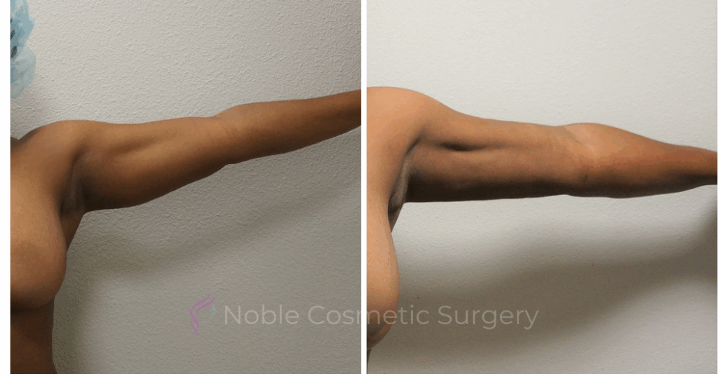 LIPOSUCTION ARMS CASE 00500