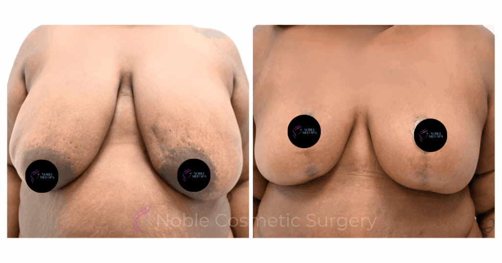 BREAST REDUCTION CASE 00804