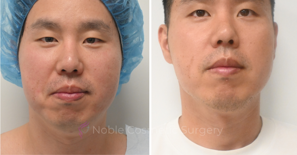 SUBMENTAL LIPOSUCTION CASE 10214