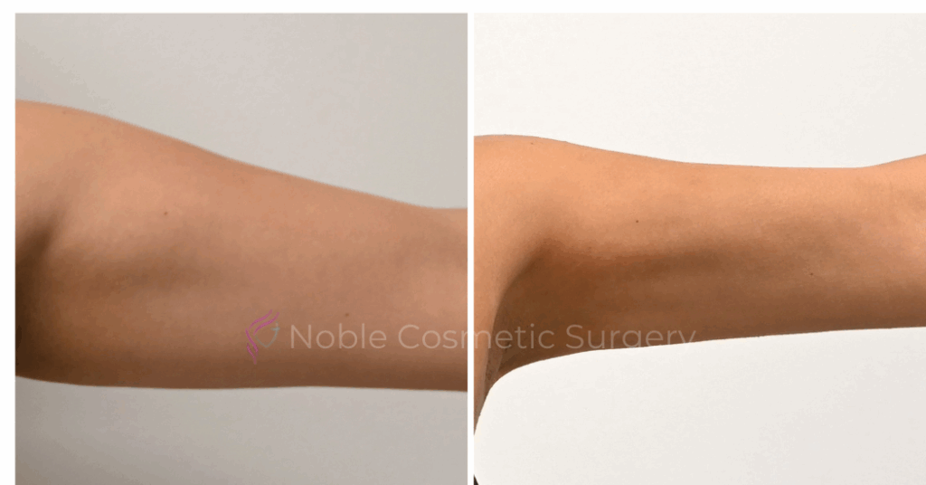 LIPOSUCTION CASE 00316
