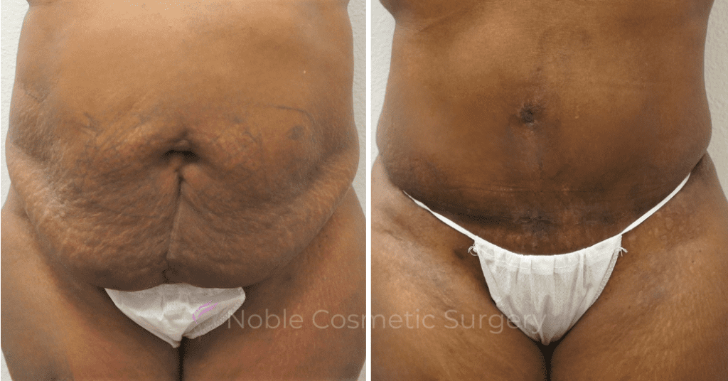 TUMMY TUCK CASE 00303
