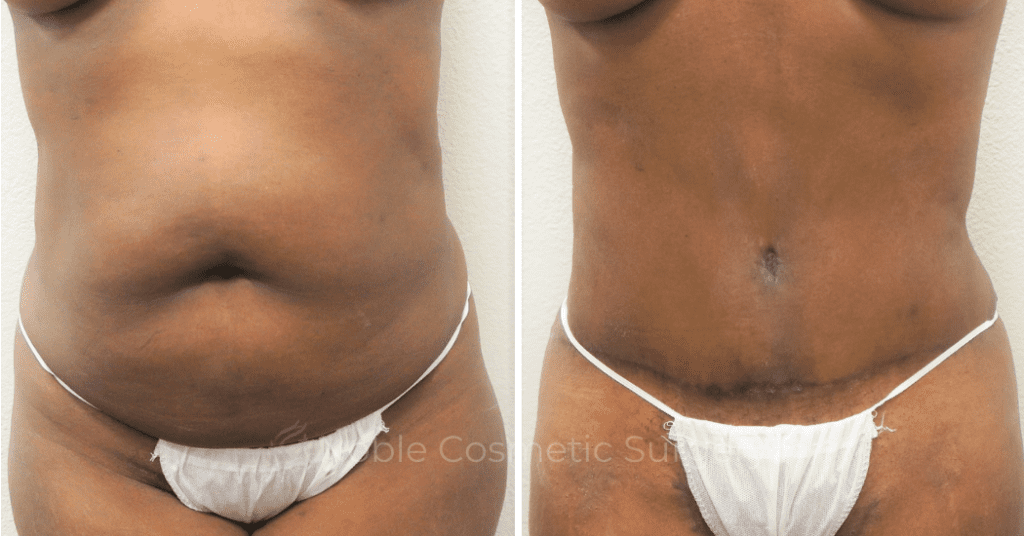 TUMMY TUCK CASE 00305