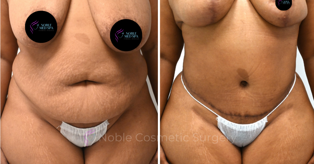 TUMMY TUCK CASE 00309