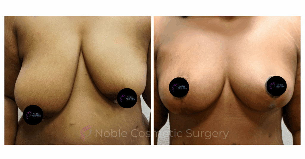 BREAST REDUCTION CASE 00801