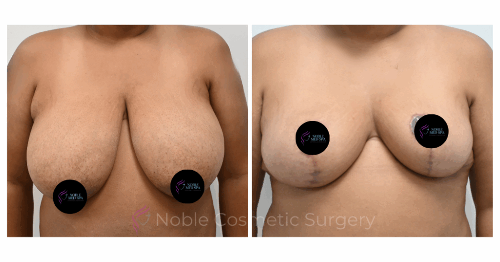 BREAST REDUCTION CASE 00803