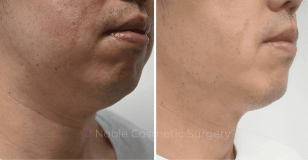 SUBMENTAL LIPOSUCTION CASE 10214