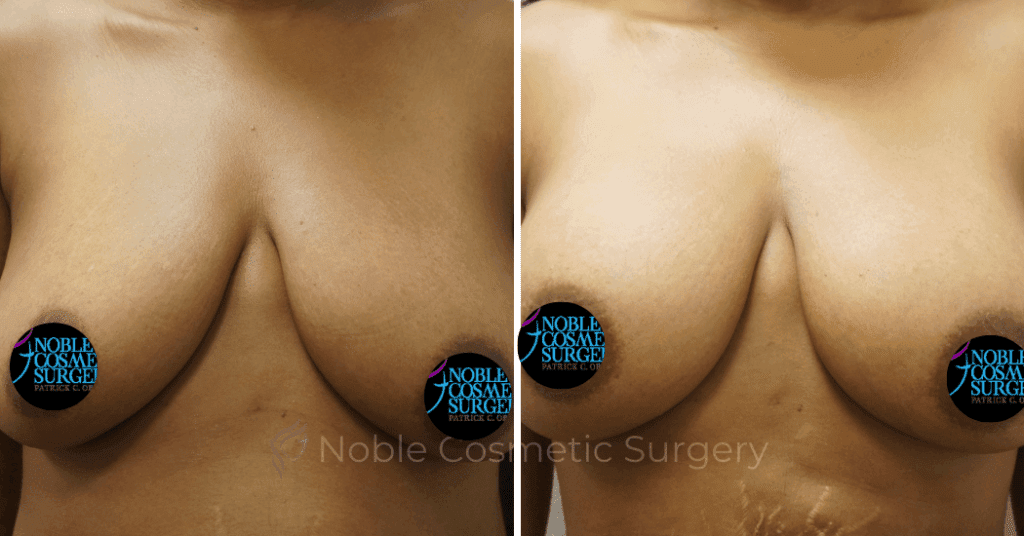 BREAST AUGMENTATION CASE 00268