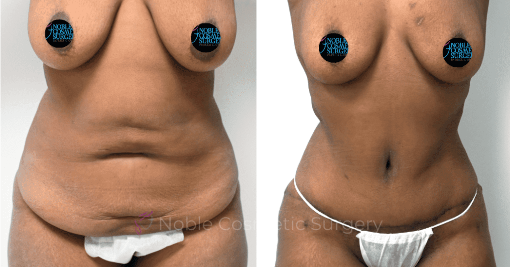 TUMMY TUCK CASE 00318
