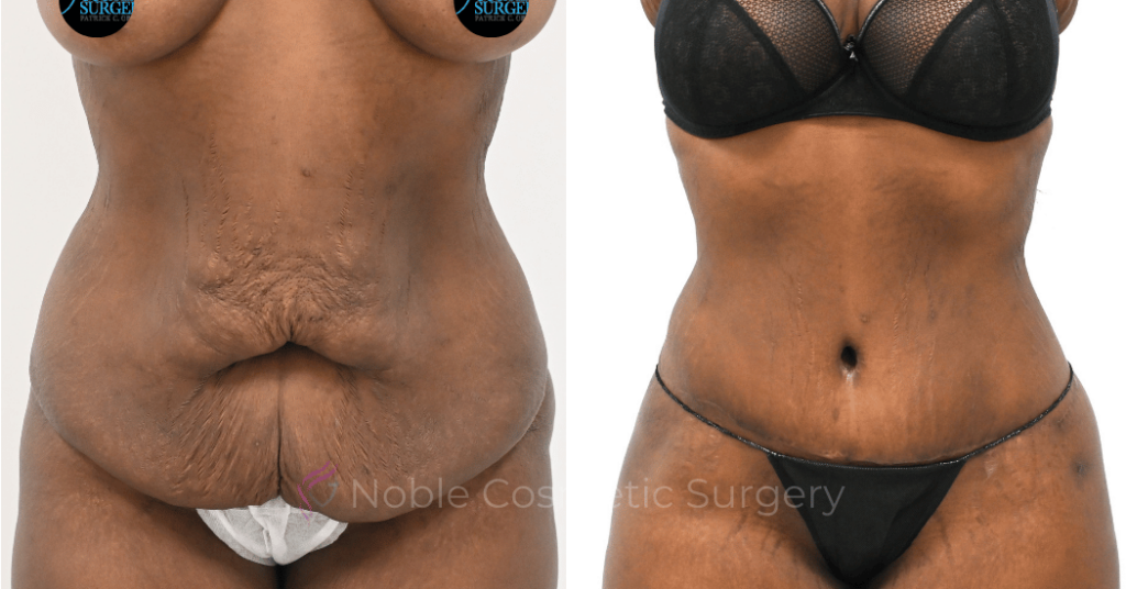 TUMMY TUCK CASE 00319