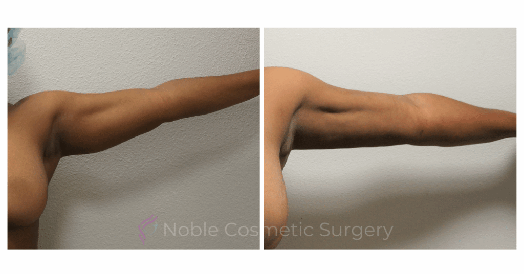 ARM LIFT CASE 00500
