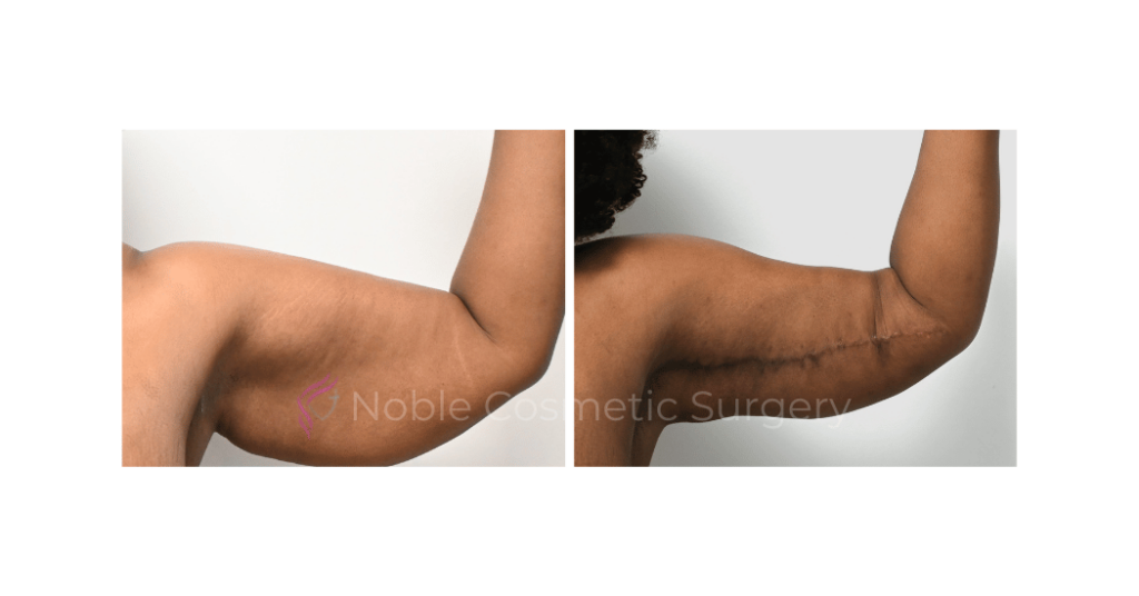 ARM LIFT CASE 10784