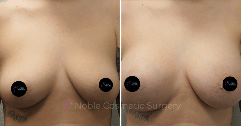 BREAST AUGMENTATION  WITH LIFT  CASE 00311