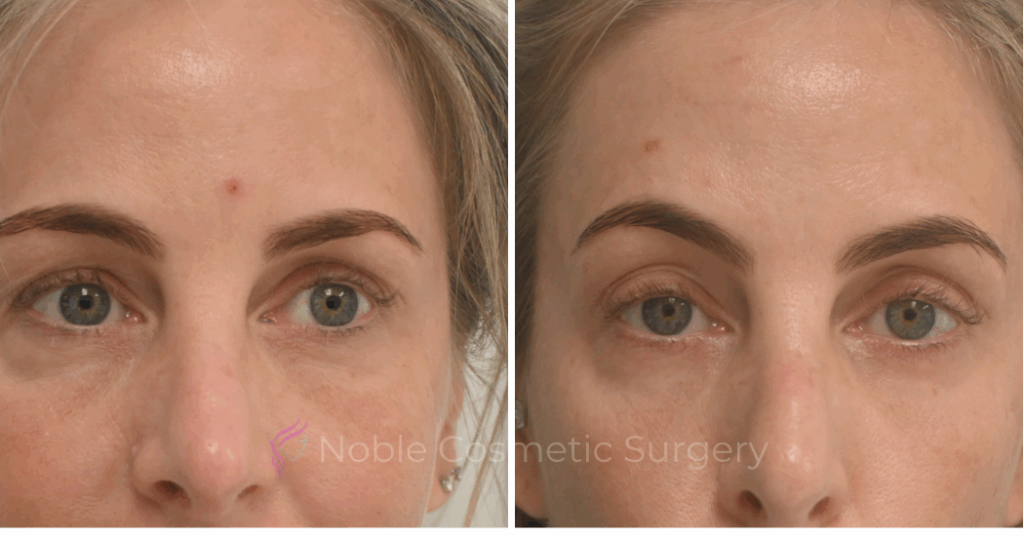 LIQUID RHINOPLASTY CASE 10007