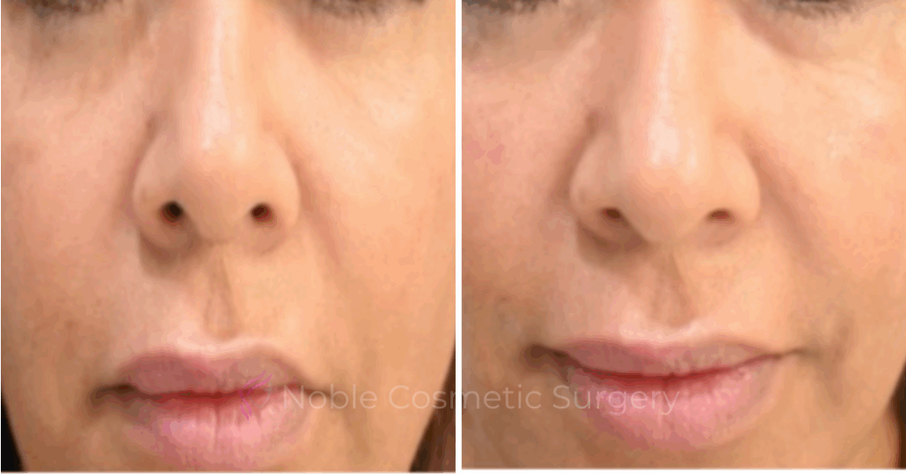 LIQUID RHINOPLASTY CASE 10004