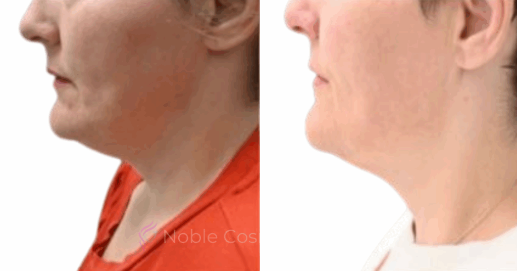 KYBELLA CASE 00200