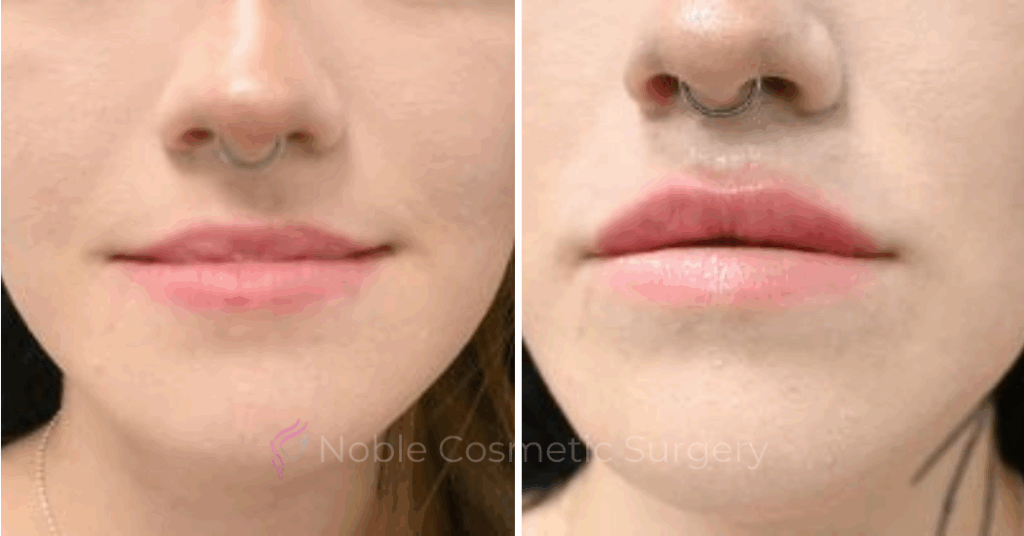DERMAL FILLERS CASE 00265