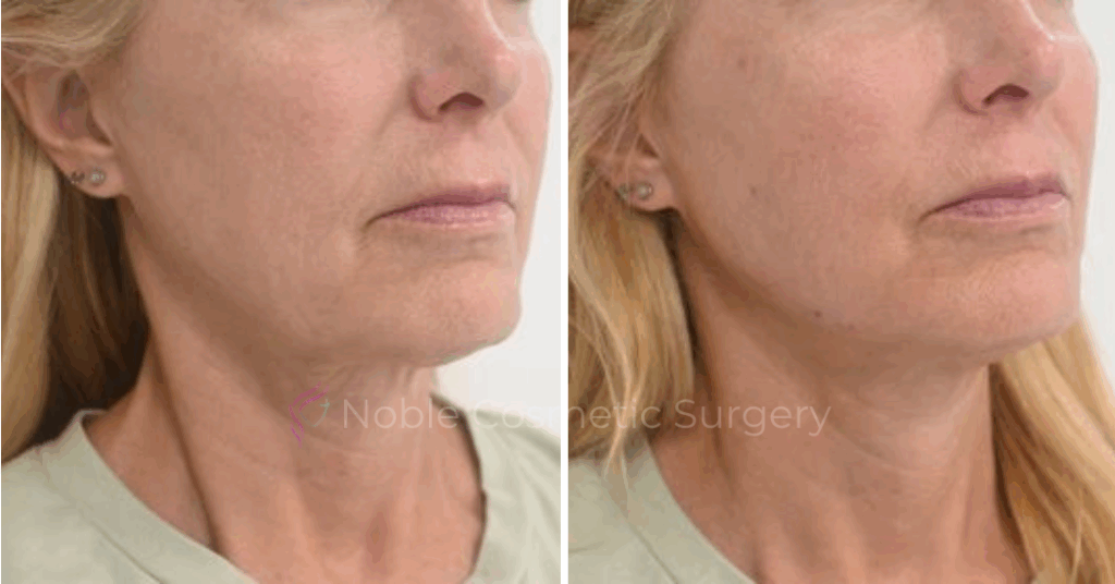 RF MICRONEEDLING CASE 00050