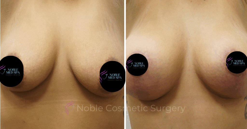 BREAST AUGMENTATION  WITH LIFT  CASE 00309