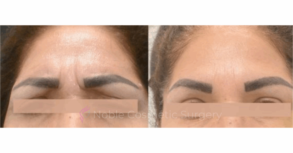 BOTOX CASE 10011
