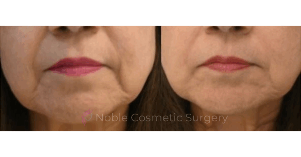 BOTOX CASE 10012