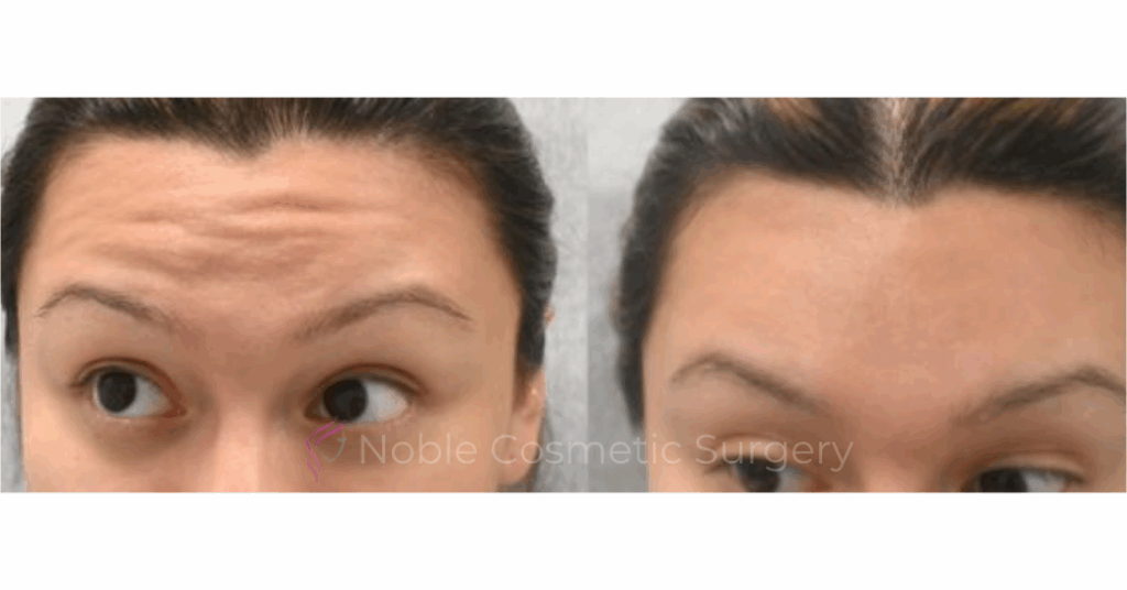 BOTOX CASE 10013