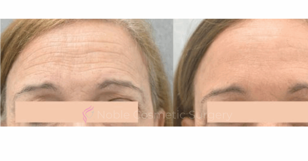 BOTOX CASE 10014