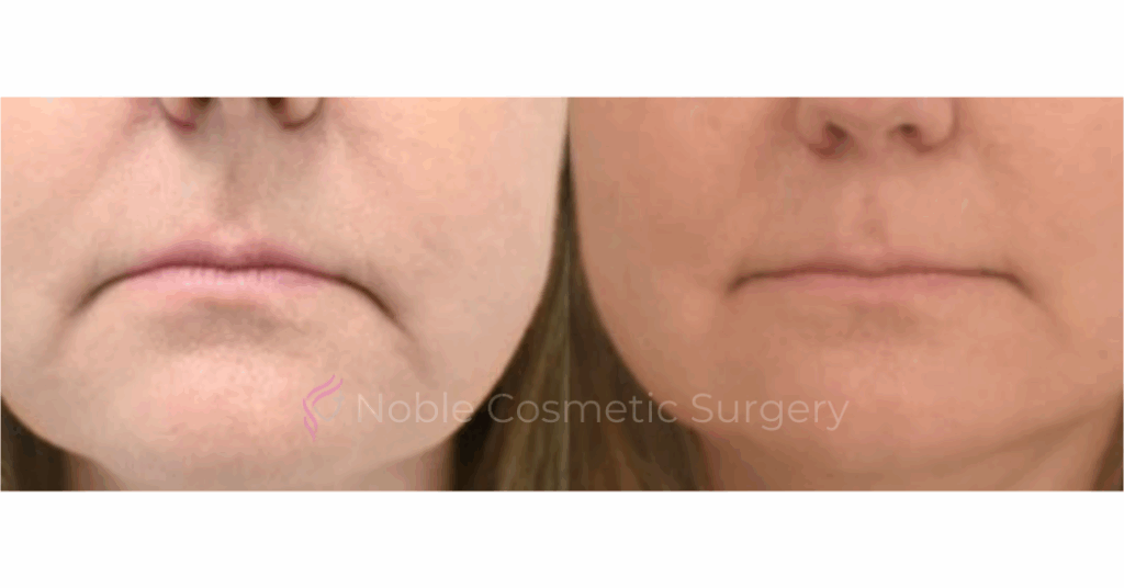 BOTOX CASE 10015