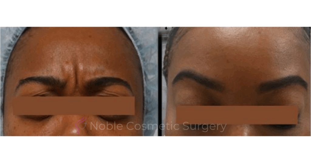 BOTOX CASE 10016