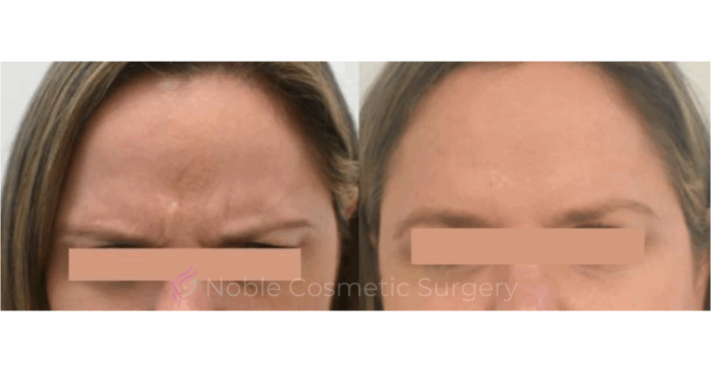 BOTOX CASE 10017