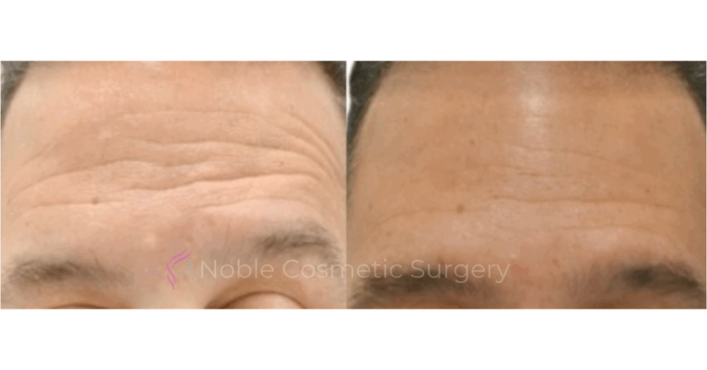 BOTOX CASE 10018