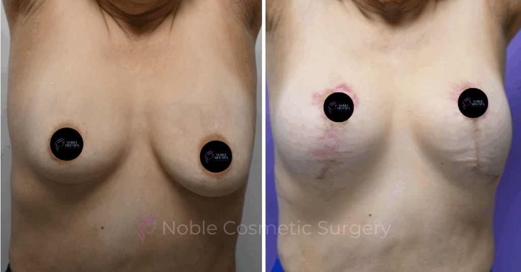 BREAST AUGMENTATION  WITH LIFT  CASE 11535