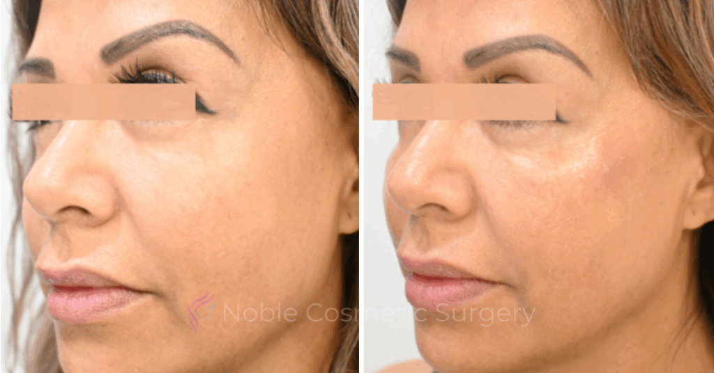 RF MICRONEEDLING  CASE 00080