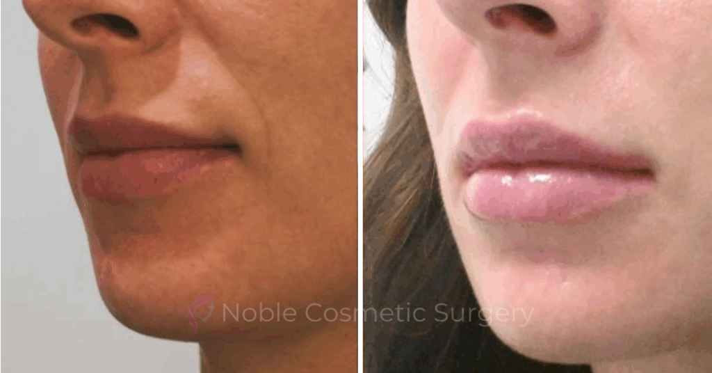 DERMAL FILLERS CASE 00260