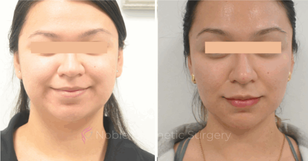 LIQUID RHINOPLASTY CASE 10006