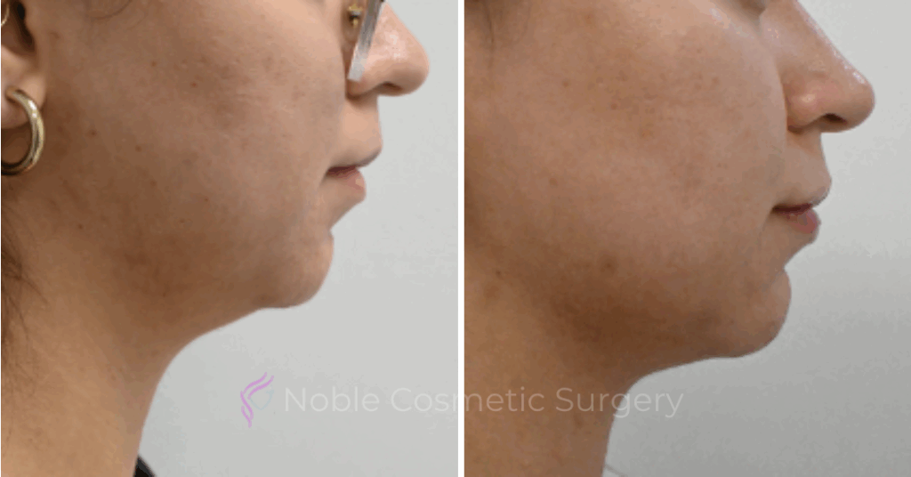 LIQUID RHINOPLASTY CASE 10005