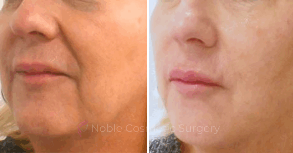 DERMAL FILLERS CASE 00262